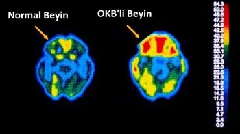 OKB (Obsesif Kompulsif Bozukluk) Nedir?